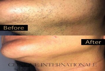 Laser hair removal